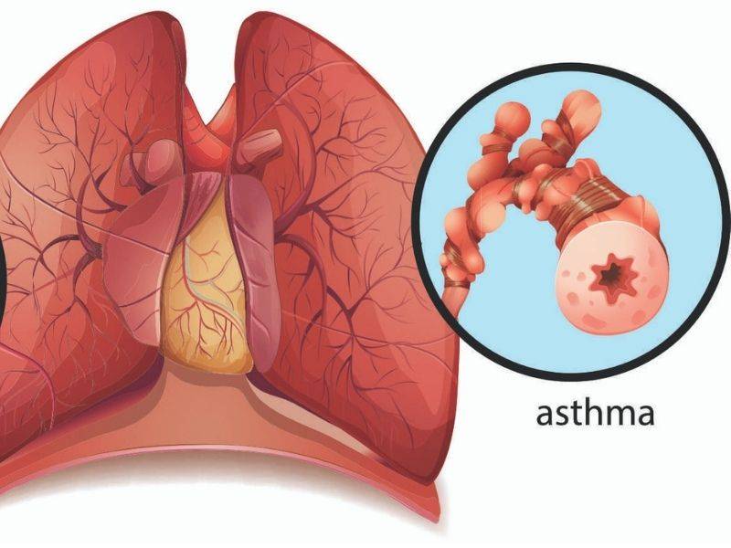 7 Makanan Ni Patut Dielakkan Oleh Penghidap Asthma. Mencegah Lebih Senang Dari Merawat .